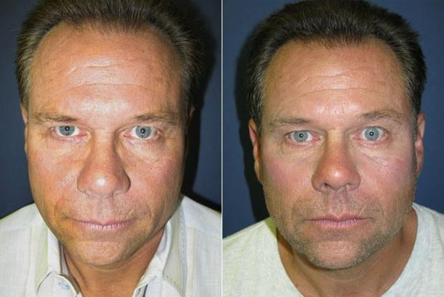 truck driver mans man dad turns to botox and fillers to impress at daughters weddings 5f6221299f806