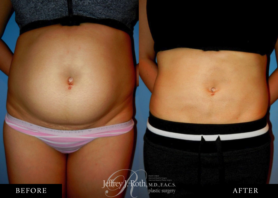 Stomach liposuction before and after