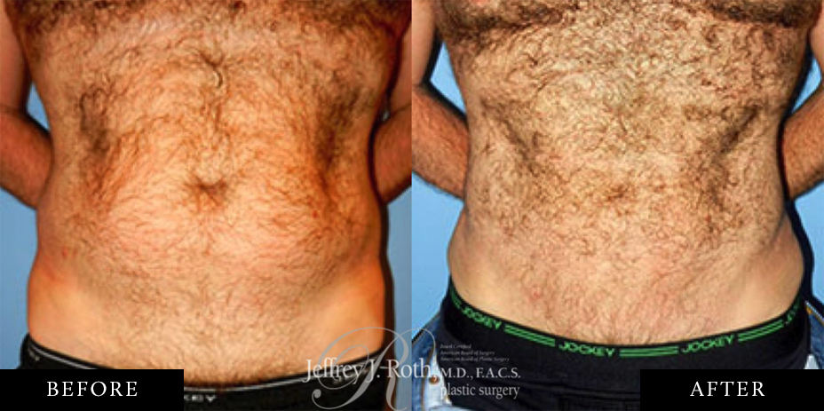 Muscle defining liposuction before and after