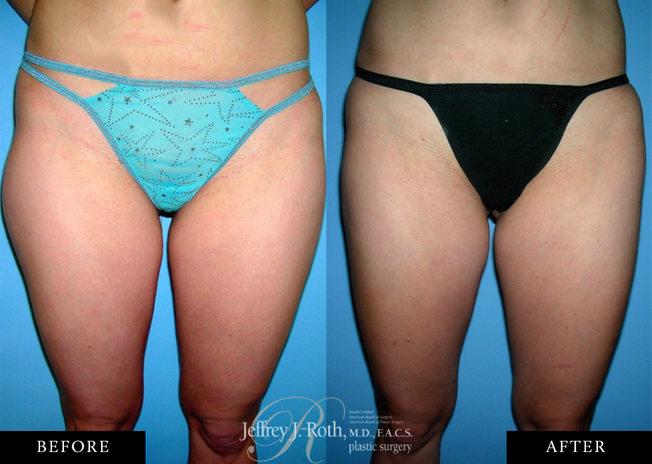 Thigh liposuction before and after