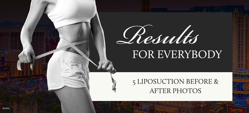 (Model) Woman measuring her abdomen with a tape measure. Text that reads "Results for Everbody. 5 liposuction before and after photos."