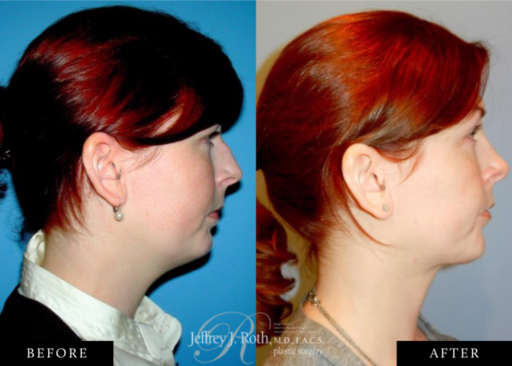 Jawline liposuction before and after