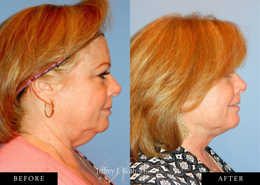 Neck liposuction before and after