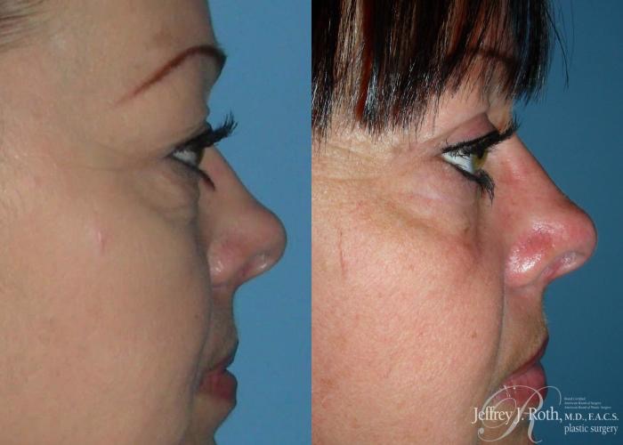 Eyelid Surgery from Dr. Jeffrey Roth