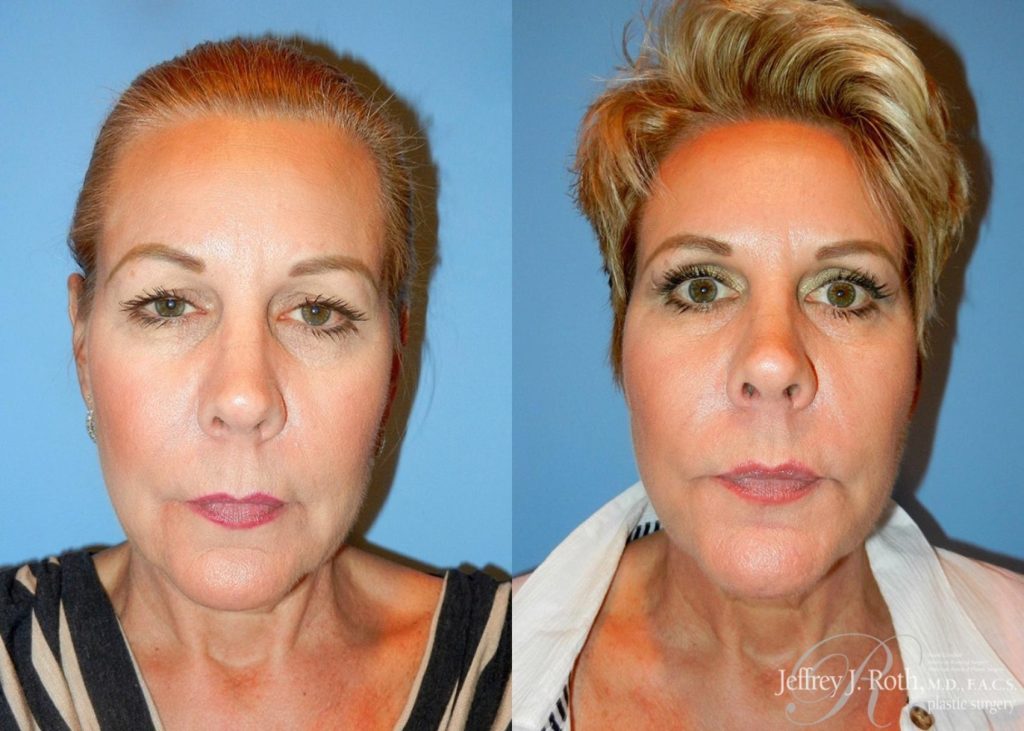 Affordable Blepharoplasty in Las Vegas