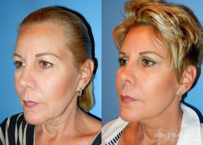 Affordable Blepharoplasty in Las Vegas