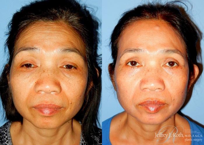 Affordable Blepharoplasty in Las Vegas