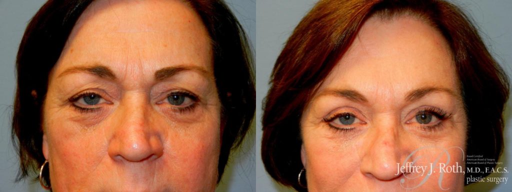 Affordable Blepharoplasty in Las Vegas