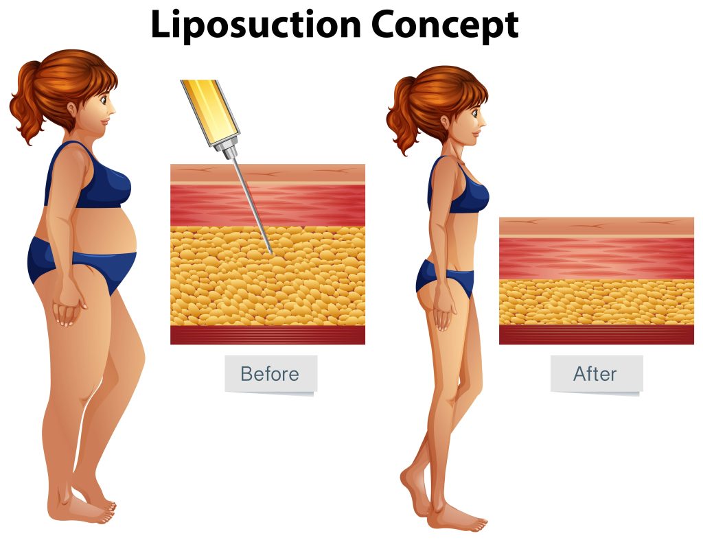 Graphic showcasing detailed information about liposuction procedures offered at Las Vegas plastic surgery